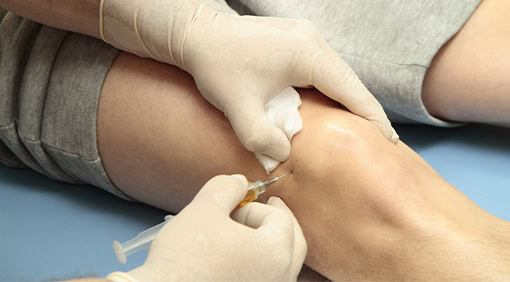 Mesenchymal Stem Cell Therapy